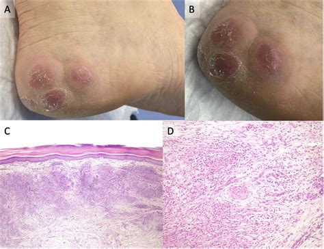 Erythema Elevatum Diutinum | Actas Dermo-Sifiliográficas