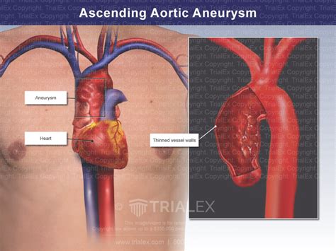 Ascending Aortic Aneurysm - Trial Exhibits Inc.