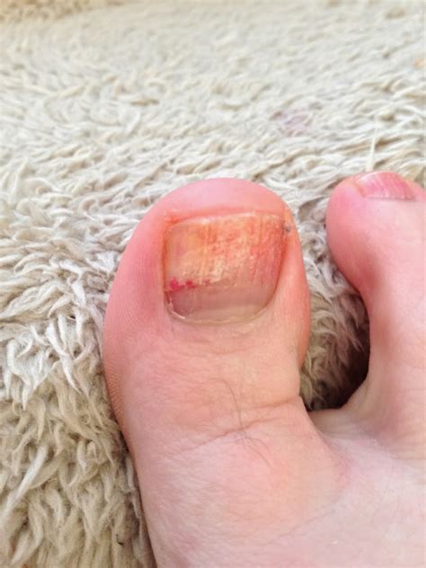 Kim Runs Miles With Smiles: I'm losing it! (my toenail)