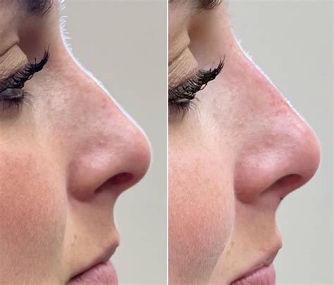 dermal fillers    pictures client  tampa bay north