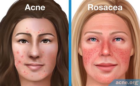 Acne vs. Rosacea - Acne.org