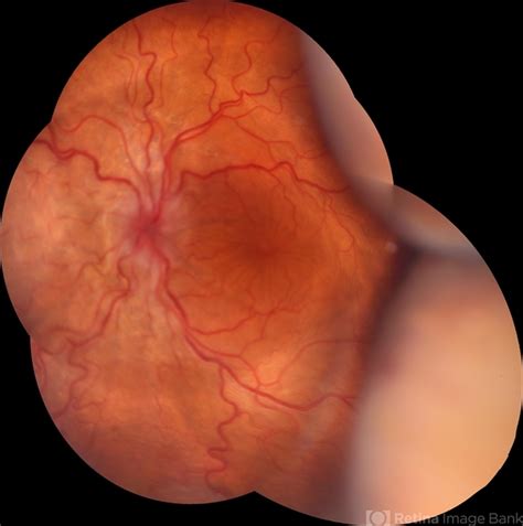 Hypotony Maculopathy: Best management strategies