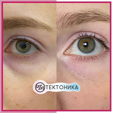 Отеки под глазами исчезли - блефаропластический массаж - Тектоника