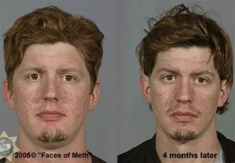 Meth Before And After | Meth Addiction | Changes Rehab