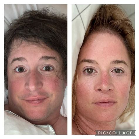 1 year of change (details below) : r/Transgender_Surgeries