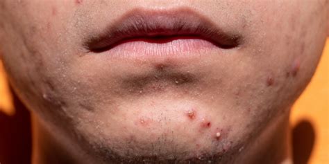 treat acne  chin  jawline treatments prevention