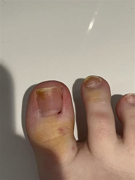 3 days post op partial nail removal : r/Ingrown_Toenails