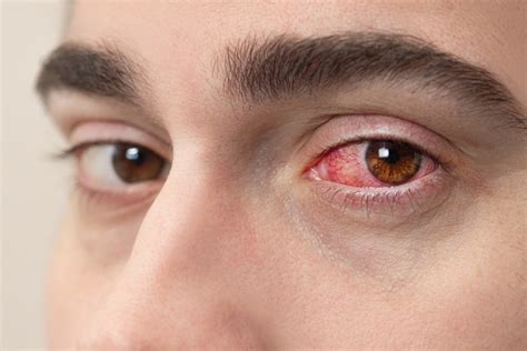 conjunctivitis     diagnosed