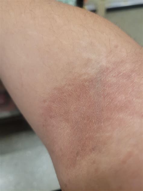 Rash(?) on Inner Elbow? : r/DermatologyQuestions