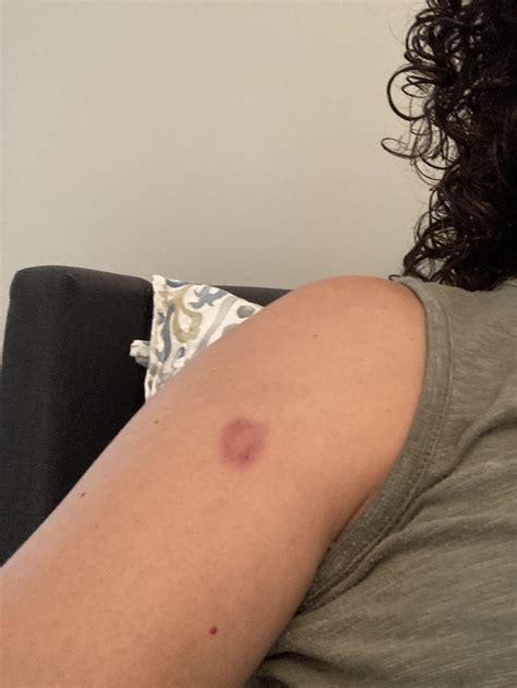 Possible moth bite/reaction. I was walking outside in Southeast Georgia