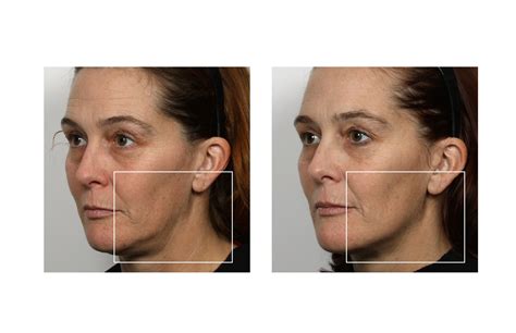 #mynuface #nuface #beforeandafter | Nuface, Earrings, Hoop earrings