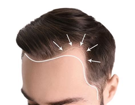 What Causes Uneven Hairline? Can It Be Fixed?