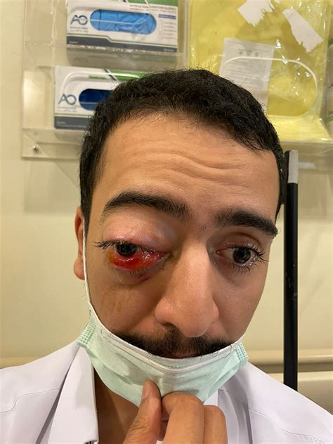 Orbital Lymphangioma presentation in the emergency department