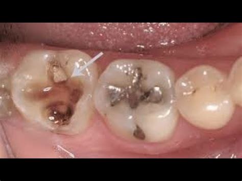 Dente Doendo E Latejando - Dente LATEJANDO ou DOENDO após a RESTAURAÇÃO! Por que? O que fazer ...