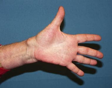 Ganglion Cyst Wrist