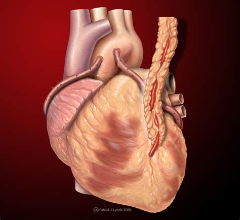 Saphenous vein graft overview - wikidoc