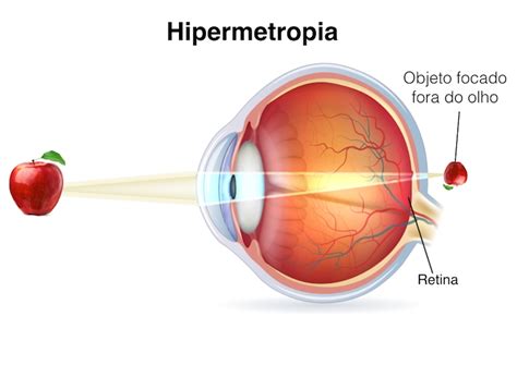 Hipermetropia O'que É - O que é uma Hipermetropia? – Clínica Oftalmológica Dr. Rui Avelino Resende