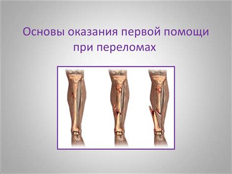 Основы оказания первой помощи при переломах - презентация онлайн