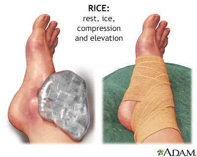 Severely Sprained Ankle Treatment
