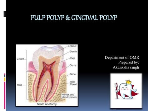 pulp polyp  gingival polyp
