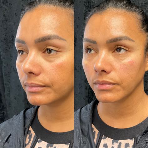 Under-Eye Fillers Pompano Beach: Smooth & Refresh Tired Eyes