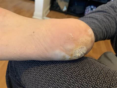 Update: Duct tape is working, kinda : r/Warts