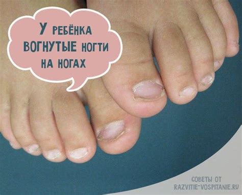 Как вылечить вросший ноготь у новорожденного ребенка?