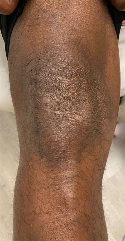 NYC Lateral Partial Knee Replacement | Robotic Partial Knee Replacement