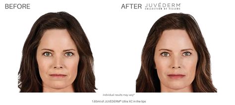 juvederm    real patient results newport news va