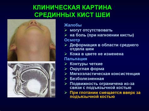 Врожденные синдромы. Врожденные кисты и свищи шеи. Дермоидные кисты ...