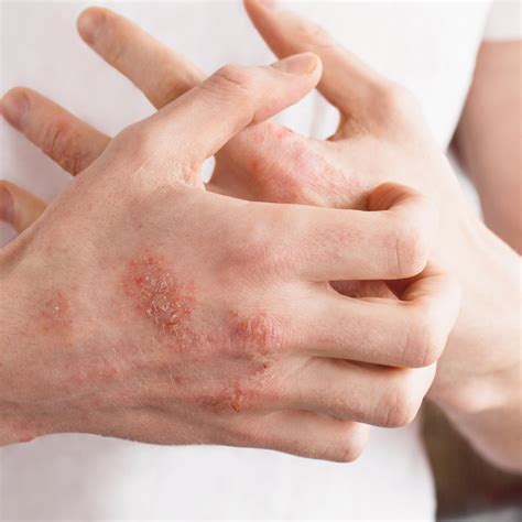 Hands, feet, elbows and knees: specific psoriasis | Eau Thermale Avène