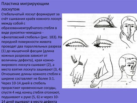 Кожная пластика - презентация онлайн