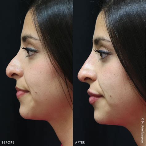 surgical rhinoplasty nose filler  san francisco bay area ca