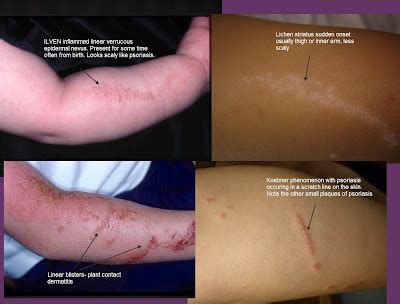 differential diagnosis  dermatology linear lesions