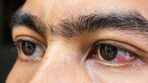 Pain and redness in one eye treatment