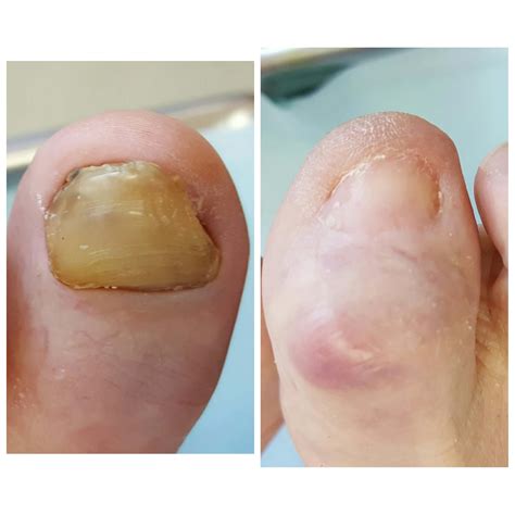 Nail Bed Excision at Kimberly Player blog