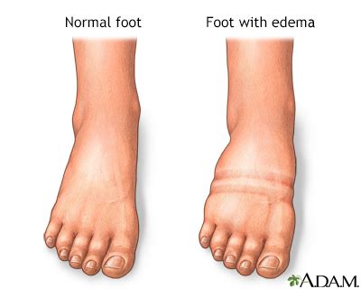 Foot, leg, and ankle swelling Information | Mount Sinai - New York