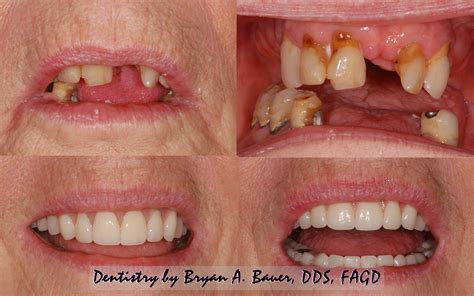 What Is Hybrid Dental Implants at Kate Wardill blog