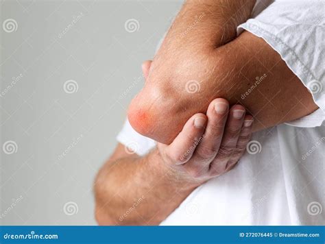 Man Has Water Swelling in Elbow Call Bursitis, Body Injured Concept. Stock Image - Image of ...