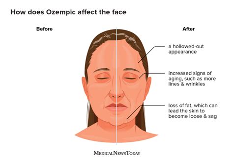 What is "Ozempic face" and how can people avoid it?
