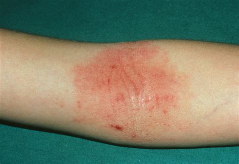 Eczema Causes, Symptoms, & Treatments - How to Get Rid of Eczema