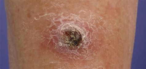 skin cancer types squamous cell carcinoma