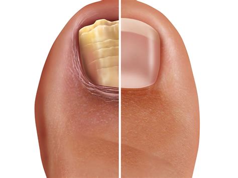 Fungal Toenails - Podiatry Quest