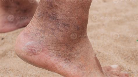Corns, calluses on the heels of an elderly man's feet, inflamed dilated