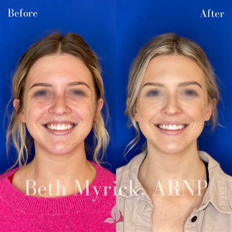 Lip Flip in Seattle at Bellora Medical Aesthetics - Nonsurgical, No ...