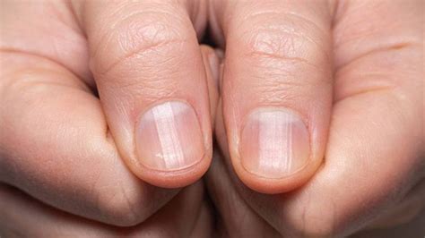 Ridges in Fingernails: Types, Causes, and Treatment – Page 4 – Entirely ...