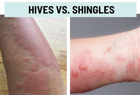 Hives (Urticaria) vs. Rash: Pictures and Differences