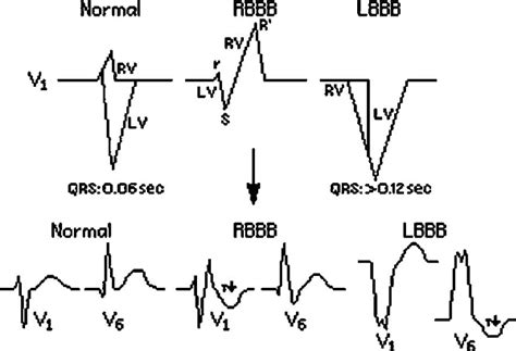 The difference between the normal narrow QRS and wide QRS as seen in ...