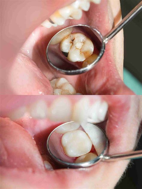 composite fillings straits area dental