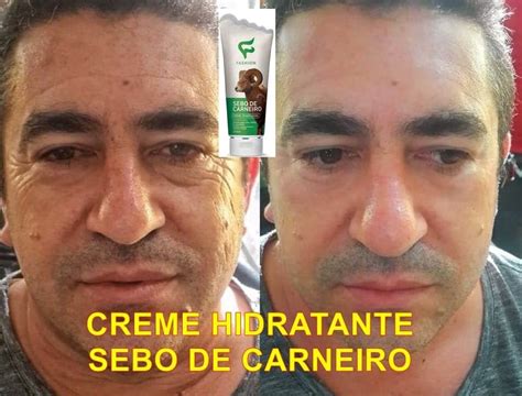 Sebo De Carneiro No Rosto Antes E Depois